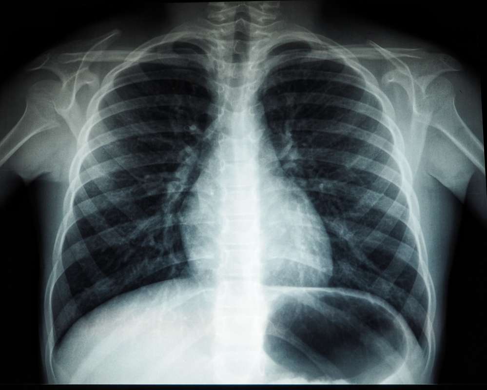 collapsed lung x ray