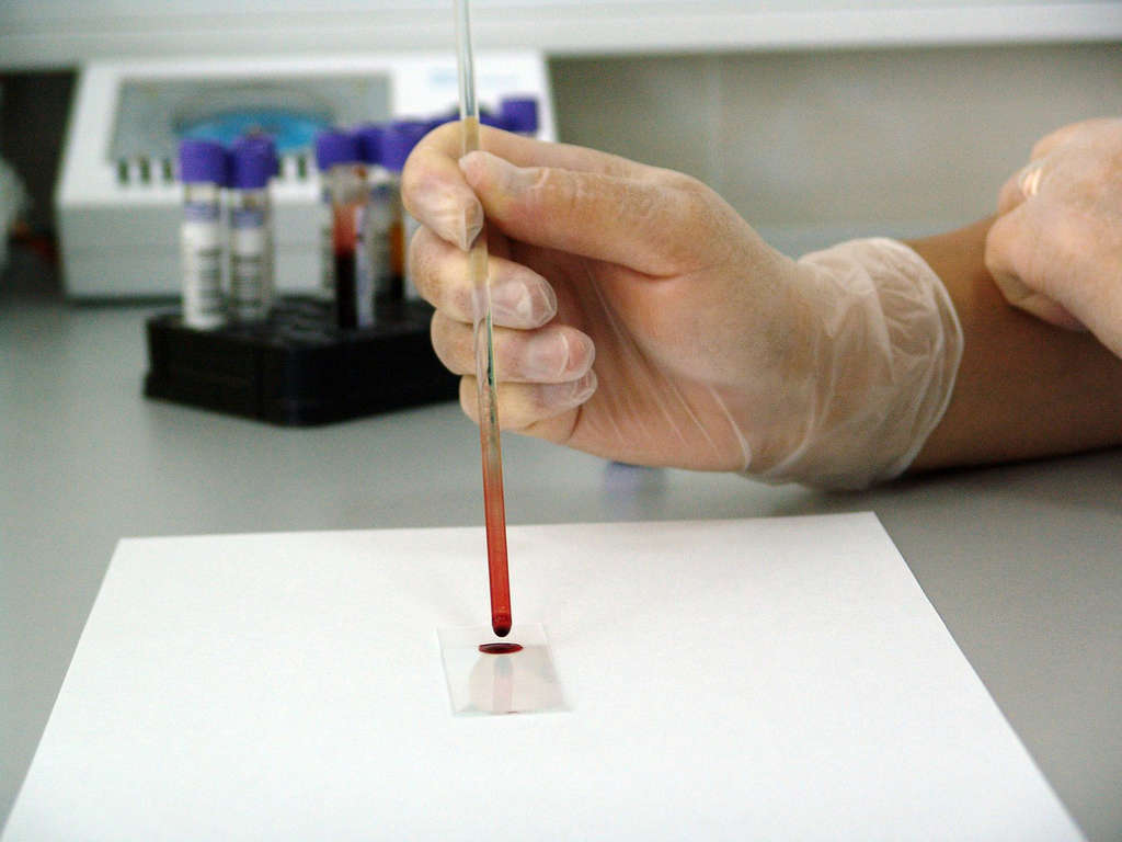 Antibody titer blood test
